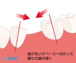 総入れ歯