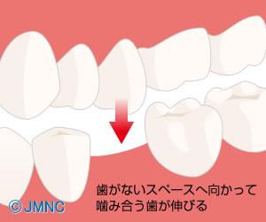 総入れ歯