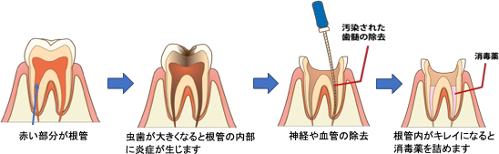 寝れ 痛く ない 歯 が て