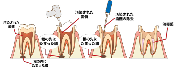 感染 根 管 処置 と は