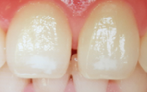 ホワイトスポット治療iconとは南小岩の歯医者 小野寺歯科医院 南小岩の歯医者 小野寺歯科医院